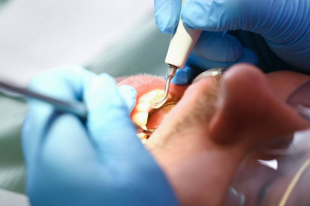 Best Broken or Cracked Tooth Emergency Dentist in La Fayette, AL